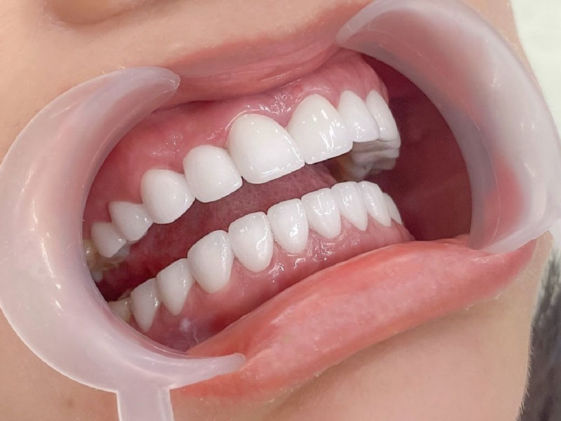 Răng giả có hình dáng, kích thước, màu sắc tương đồng với răng thật