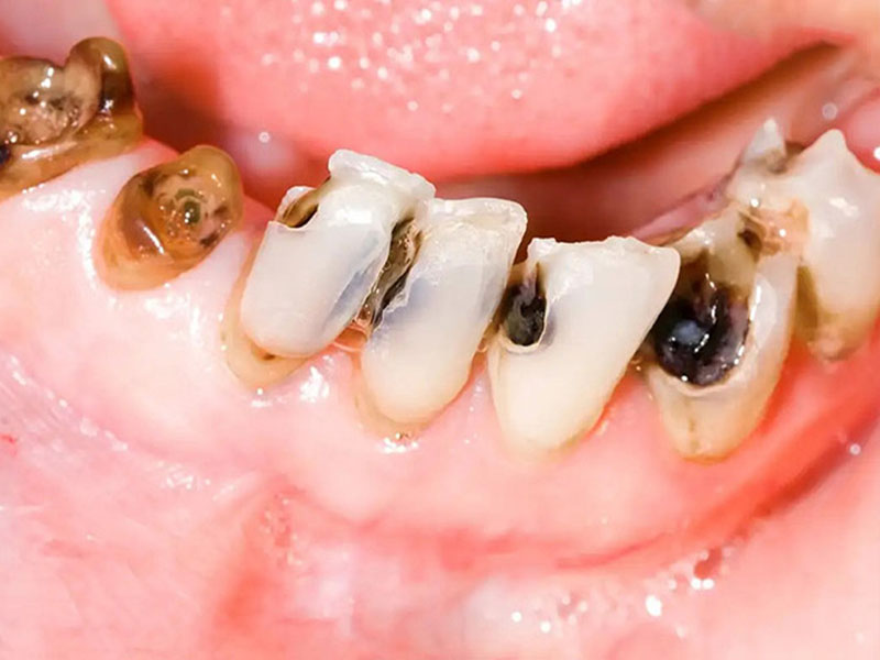 Răng bị sâu vỡ chỉ còn chân răng không nên bọc răng sứ