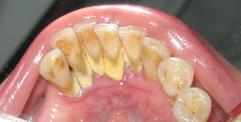Lấy cao răng là quy trình vệ sinh sạch sẽ các mảng bám, vôi trên nướu răng