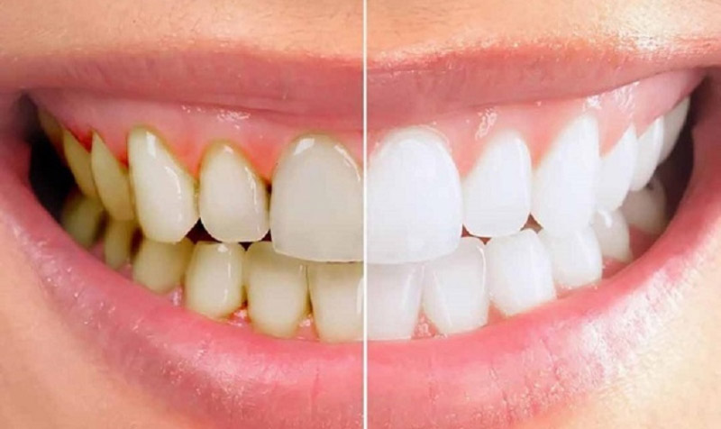Cao răng sẽ gây mất thẩm mỹ cho toàn hàm khi có màu vàng nhạt