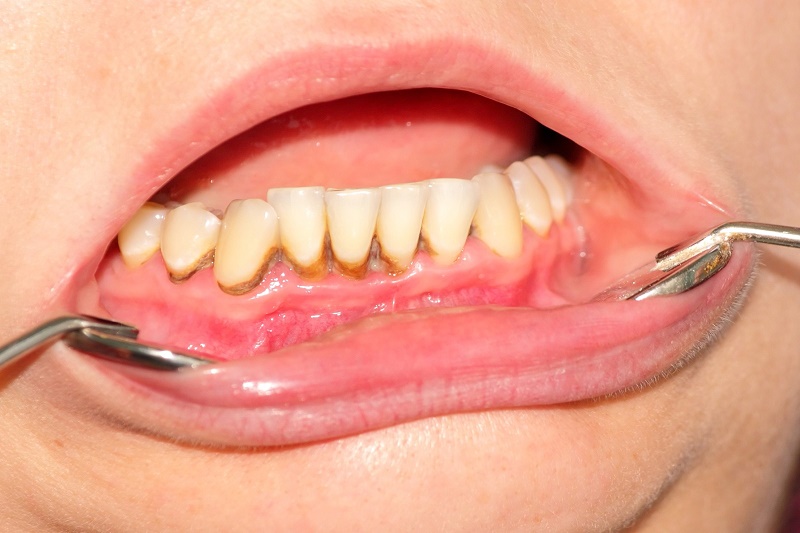 Đối tượng nên lấy cao răng thường xuyên