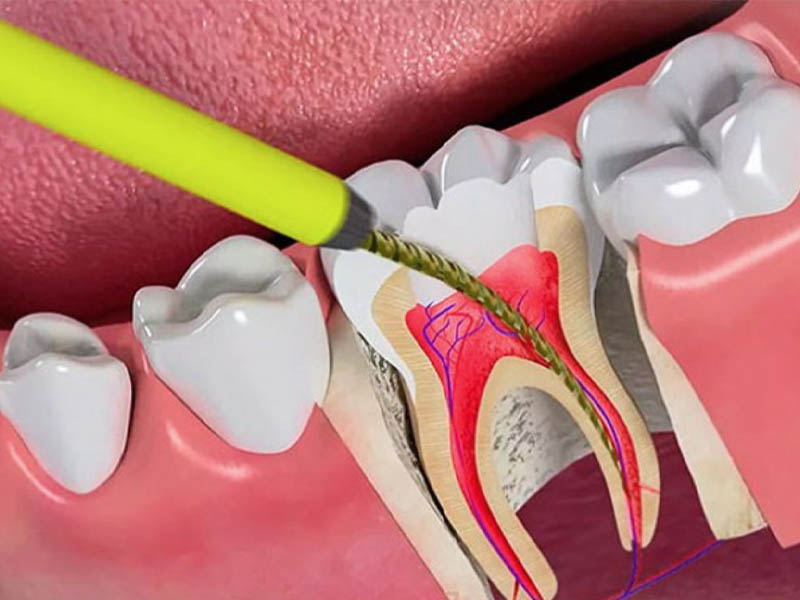Điều trị tủy răng lấy sạch phần tủy răng bị viêm nhiễm 