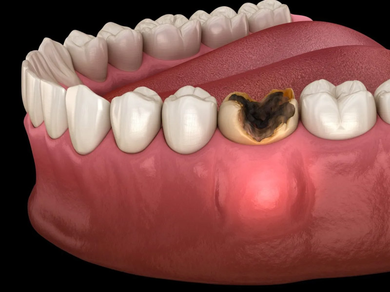 Nên điều trị tủy răng khi răng bị sâu nghiêm trọng