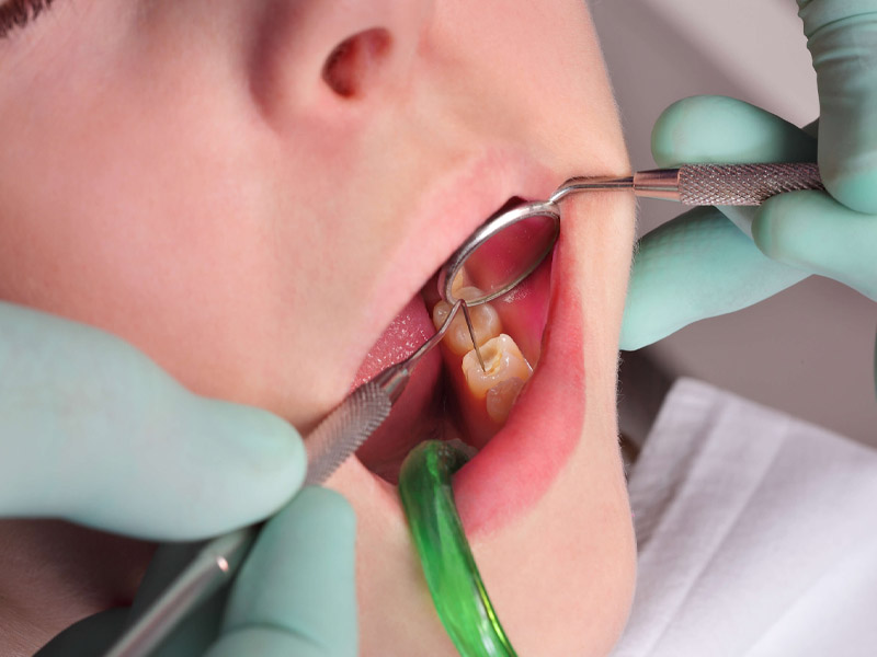 Quy trình điều trị tủy răng gồm 5 bước chuẩn Y khoa