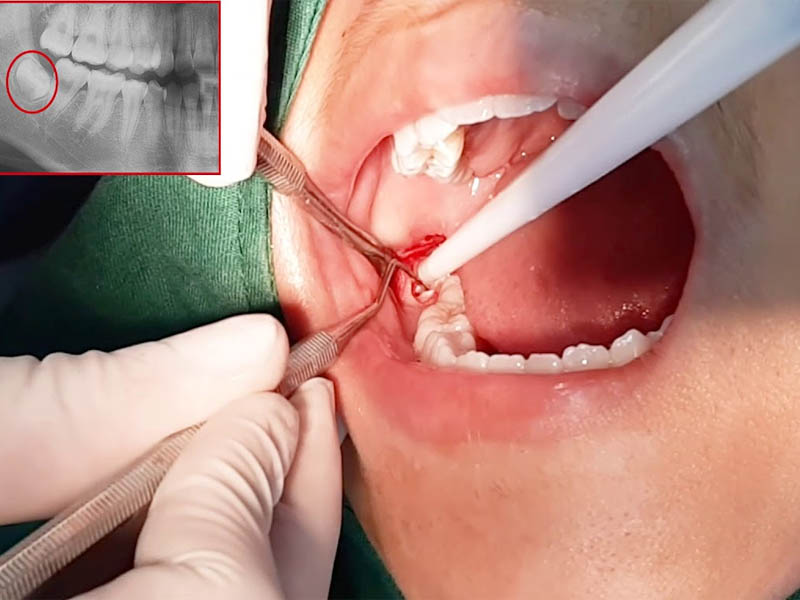 Nhổ răng khôn là thủ thuật loại bỏ một hoặc nhiều răng số 8 nhằm tránh biến chứng
