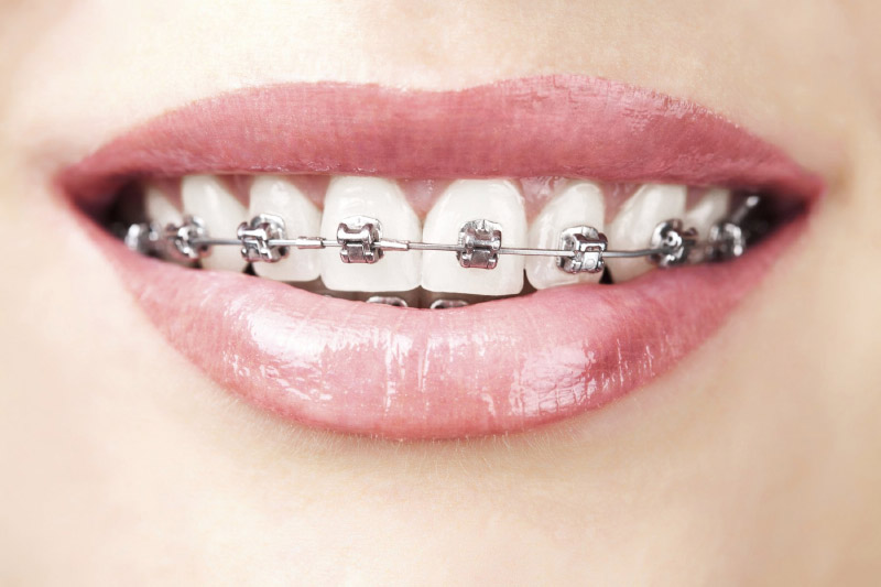 Niềng răng giúp răng dịch chuyển về đúng vị trí khớp cắn