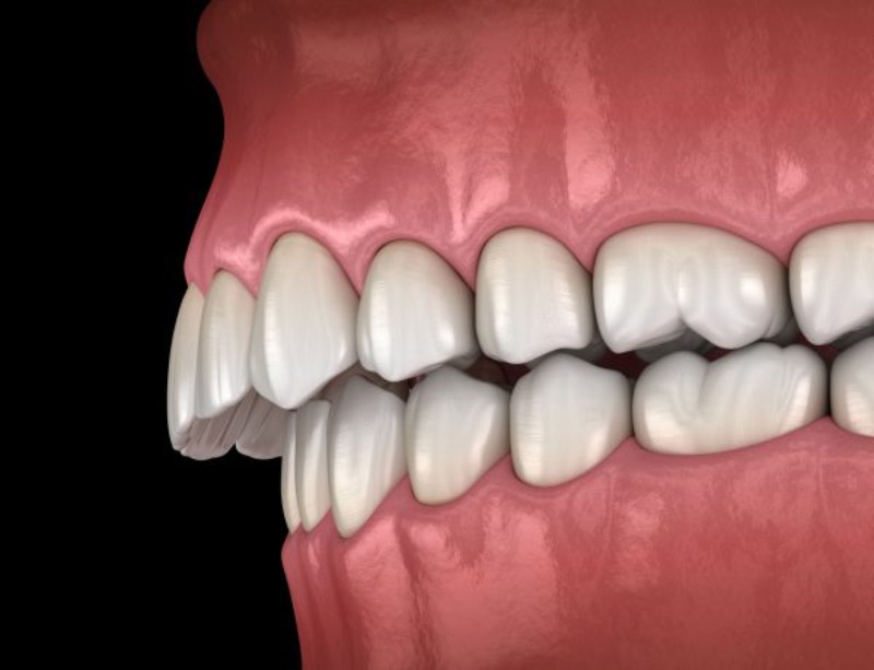 Răng bị hô cần niềng để đảm bảo tính thẩm mỹ