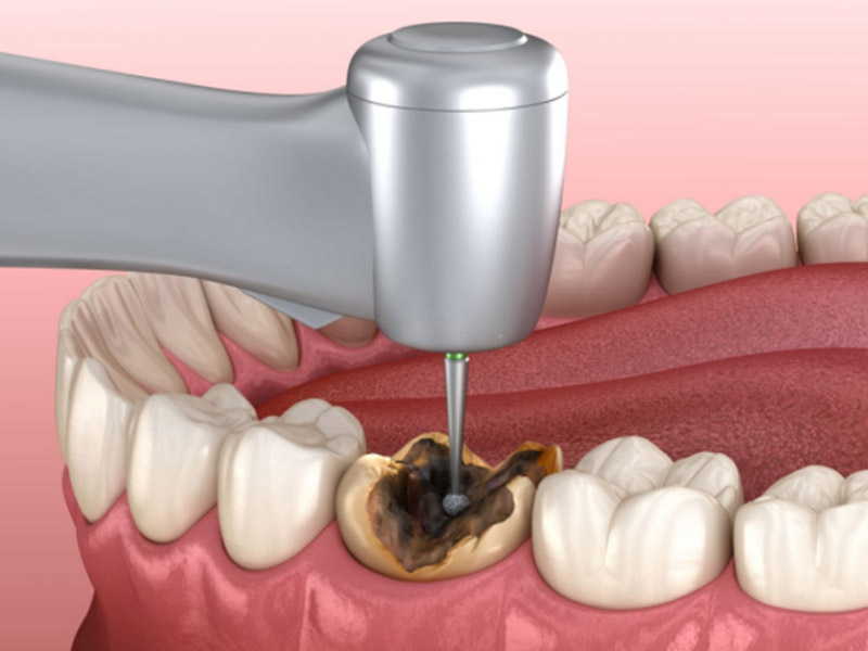 Trám răng sâu giúp loại bỏ ổ viêm, giảm đau nhức