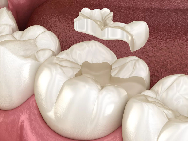 Miếng hàn răng có thể bị bong tróc do quá trình ăn uống